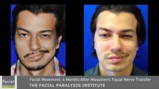 Masseter To Facial Nerve Surgery  Facial Paralysis Expert Dr Azizzadeh [upl. by Ignatzia806]