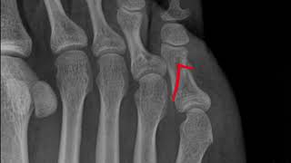 5th Toe Proximal Phalanx Fracture Xray 52 [upl. by Jeraldine]