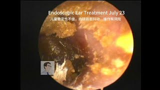 Ear wax removalCerumen embolism in children 20230723 [upl. by Dennis378]