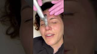 Microneedling with eclipse micro pen evo [upl. by Adli]