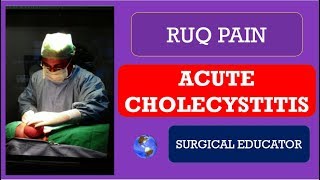 ACUTE CHOLECYSTITIS How To DIAGNOSE amp TREAT  RUQ PAIN [upl. by Lebama]