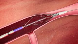 See how the Pounce™ Venous Thrombectomy System works [upl. by Herodias]