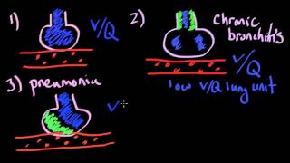 V Q mismatch amp Aa gradientmp4 [upl. by Ahseyn]