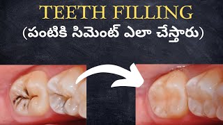 How Teeth Filling is done in Teluguపంటికి సిమెంట్ ఎలా చేస్తారు [upl. by Anifares]