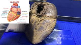 Blood supply of heart or Coronary circulation  Gross and clinical anatomy [upl. by Fazeli]