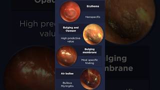 Acute Otitis Media Otoscopy [upl. by Lyell]