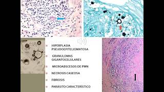 3 Paracoccidioidomicosis [upl. by Anatniuq]