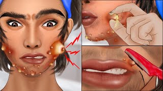 ASMR Popping pustule in jawline and face shaving Squeeze acne animation [upl. by Eenwahs]