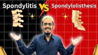 spondylitis vs spondylolisthesis  spondylitis  Spondylolisthesis  everything you need to know [upl. by Enirahtak]