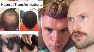 HAIR LOSS INDUSTRY Trends DESTROYING MEN [upl. by Halehs]