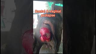 Prolapse l uterine prolapse l rectal prolapse l vaginal prolapse l dr Umar khan [upl. by Floro]