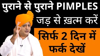 पुराने से पुराने पिम्पल्स जड़ से ख़त्म Get Rid of Pimples amp Acne Permanently  Sanyasi Ayurveda [upl. by Megen]