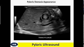 Pyloric ultrasound [upl. by Tibbs195]