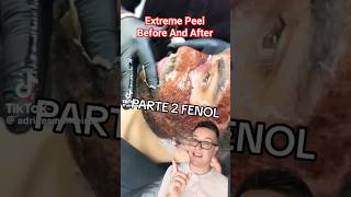 TW😱 SHOCKING CHEMICAL PEEL  Phenol Peel Before and After shorts [upl. by Lukash229]