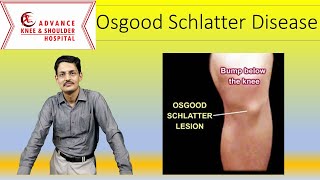 Osgood schlatter Disease [upl. by Salvadore]