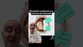 Mécanisme conduisant a un infarctus du myocarde [upl. by Tertias130]