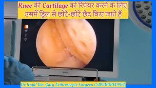 How To Repair Knee Cartilage  Dr Kapil Dev cured the cartilage of his knee [upl. by Womack227]