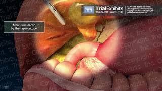 Gallbladder Removal Using the EndoCatch Specimen Retrieval System [upl. by Hildy775]