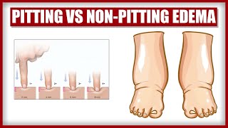 Pitting vs NonPitting Edema [upl. by Abdulla]