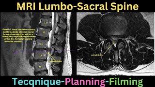 MRI Lumbo saccral spine technique plannning and filming tutorial [upl. by Aicnelav]