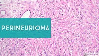 PerineuriomaExplained by a Soft Tissue Pathologist [upl. by Akehsyt280]