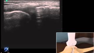 How To Ultrasound Exam of the Medial Collateral Ligament 3D Video [upl. by Sasnak]