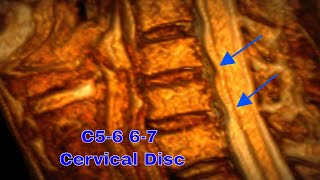 3D MRI로 보는 C56 C67 경추 디스크 이해하기 Understanding C56 C67 Cervical Disc Herniation in 3D MRI [upl. by Nal983]