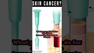 Skin Cancer Dont Ignore The Warning Signs [upl. by Awhsoj575]