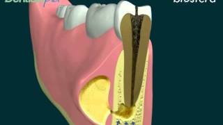 Ascesso la terapia endodontica [upl. by Eitten]