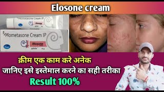 Eloson cream use benefits and Side effects full review in hindiMometasone01 [upl. by Jahn]