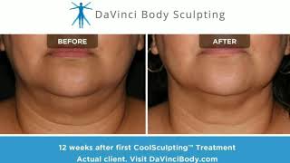 WOW Stunning CoolSculpting Chin Results [upl. by Kreiner]