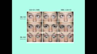 Strabismus  CRASH Medical Review Series [upl. by Einon798]