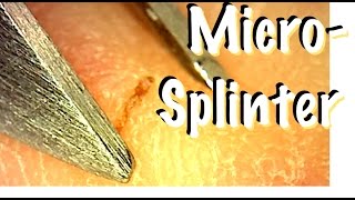 Pulling Micro Splinter out of Hand [upl. by Akeemahs]