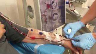 Dialysis connection of a patient with an arteriovenous fistula [upl. by Nyrrek]