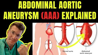 Understanding Abdominal Aortic Aneurysms [upl. by Bust]