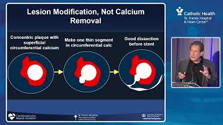 Excimer Laser Atherectomy – When and how to use it [upl. by Eloccin38]