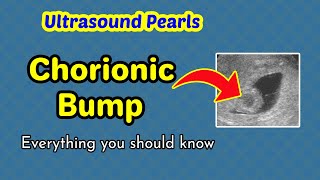 Ultrasound Pearls Chorionic Bump [upl. by Richmal]