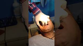 THE UPPER SECOND PREMOLAR TOOTH EXTRACTION [upl. by Highams]