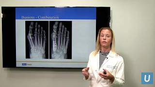 Bunions amp Hammertoes  Joan Williams MD  UCLAMDChat [upl. by Nnylram]