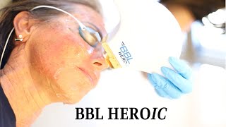 What is BBL HEROic Laser Treatment [upl. by Eads]