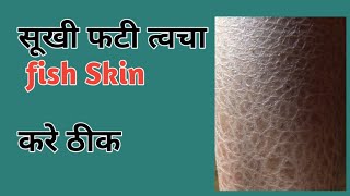 Ichthyosis Vulgeris Cause Symptoms and Treatment Hindi [upl. by Suivart]