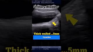 Ultrasound Cystitis of 21yrs Boy with Residual Urine [upl. by Oirom]