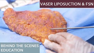 How does Vaser Liposuction work [upl. by Atteuqnas]