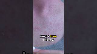 Aquagenic Urticaria The Unbelievable Water allergy [upl. by Genia]