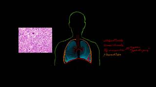 Respiratorisk svikt 13 Pneumoni [upl. by Ritter]