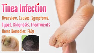 Tinea overview causes sign and symptoms diagnosis treatment home remedies and FAQs [upl. by Neehs]