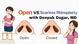 What is a Closed Rhinoplasty quotScarless Nosequot vs Open Rhinoplasty by Dr Deepak Dugar Beverly Hills [upl. by Obbard]