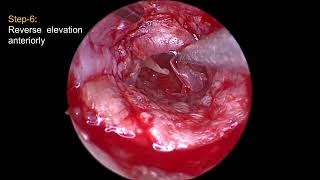 ENDOSCOPIC TWO HANDED INTERLAY TYMPANOPLASTY By DrJego Ori [upl. by Essila]