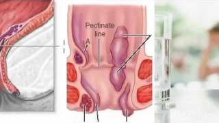 External Hemorrhoids Treatment [upl. by Ehrman]