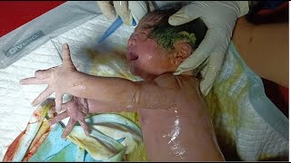 melahirkanbersalin bayi besar 34 kg girl air ketuban keruh karena bercampur fes3s [upl. by Fasta]